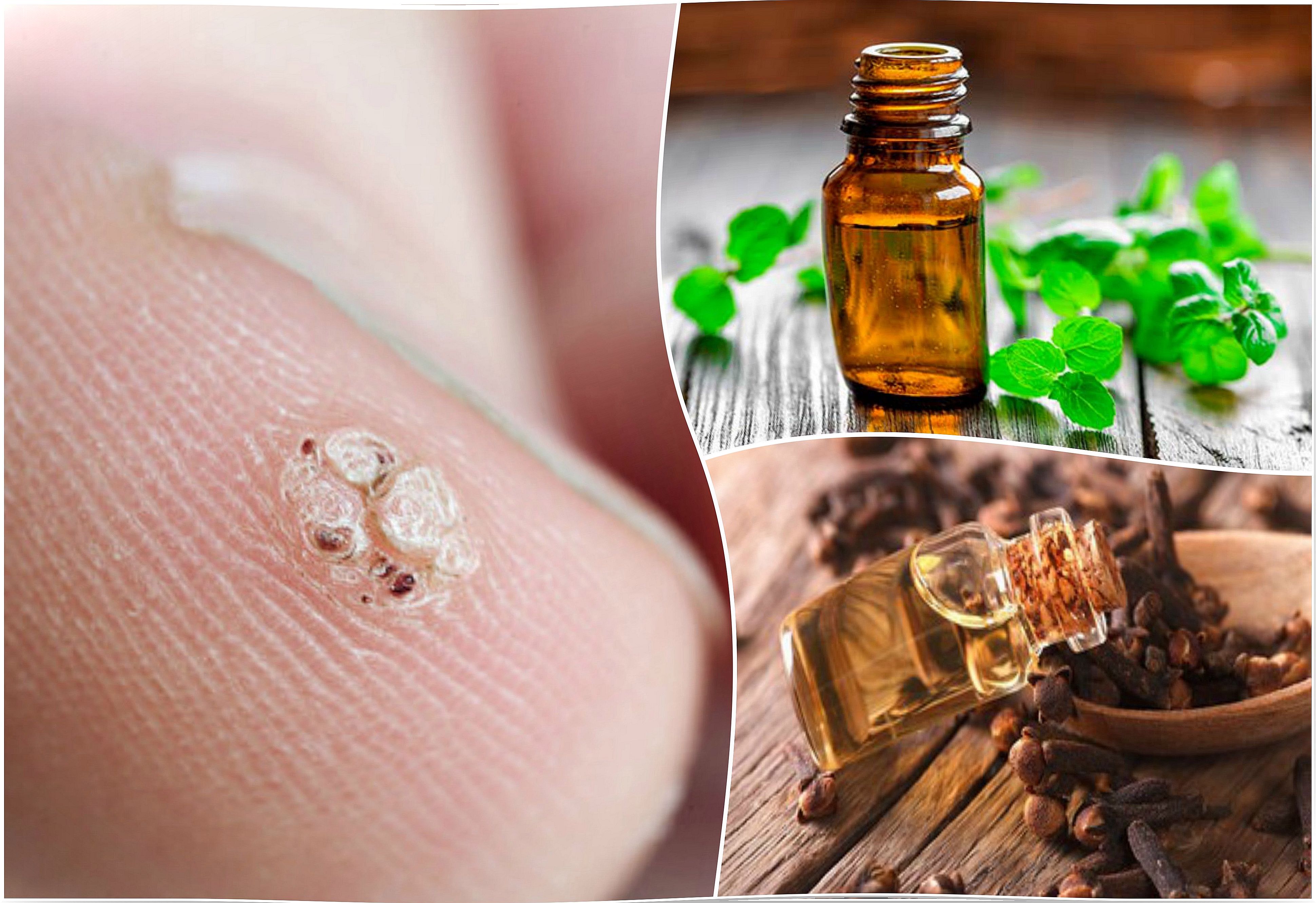 7 essential oils that will help you fight warts