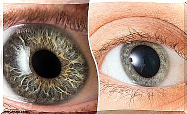 Anisocoria or asymmetry in pupil dilation