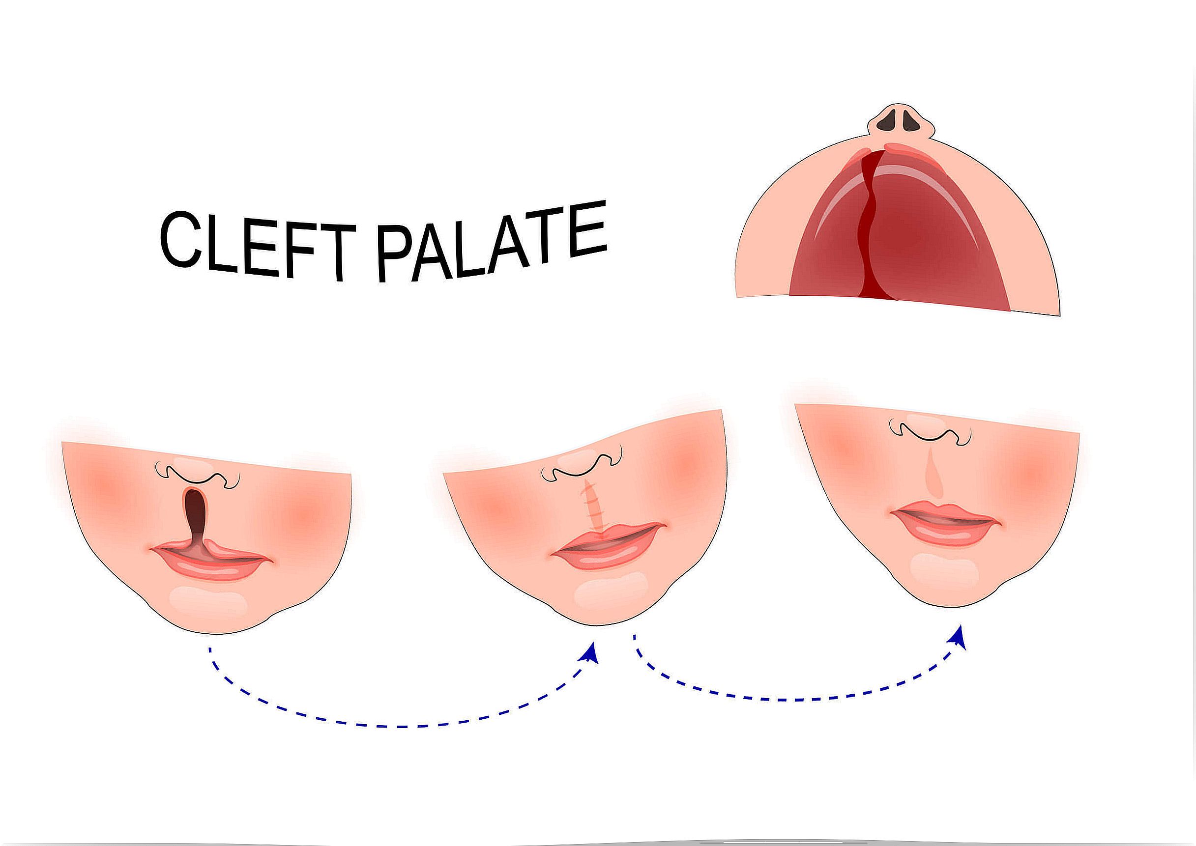 Cleft lip is accompanied by other malformations.