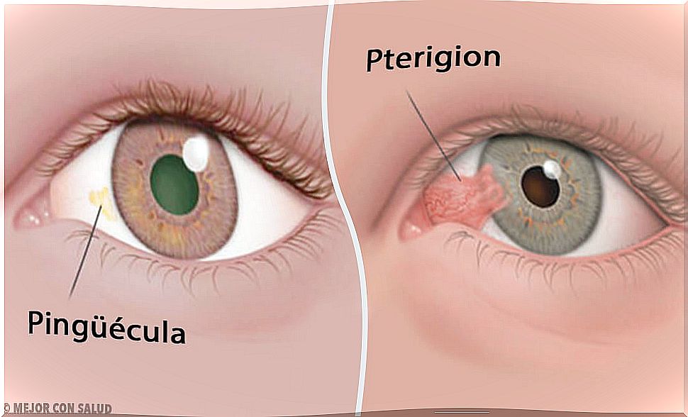 Corneal tumors: pinguecula and pterygium