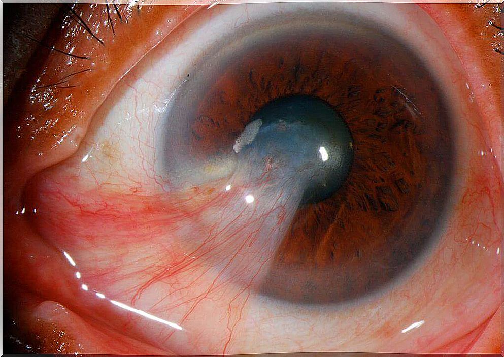 Pterygium;  differs from pinguecula because it develops from one end of the conjunctiva towards the cornea