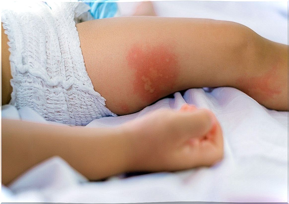 Symptoms of diaper rash