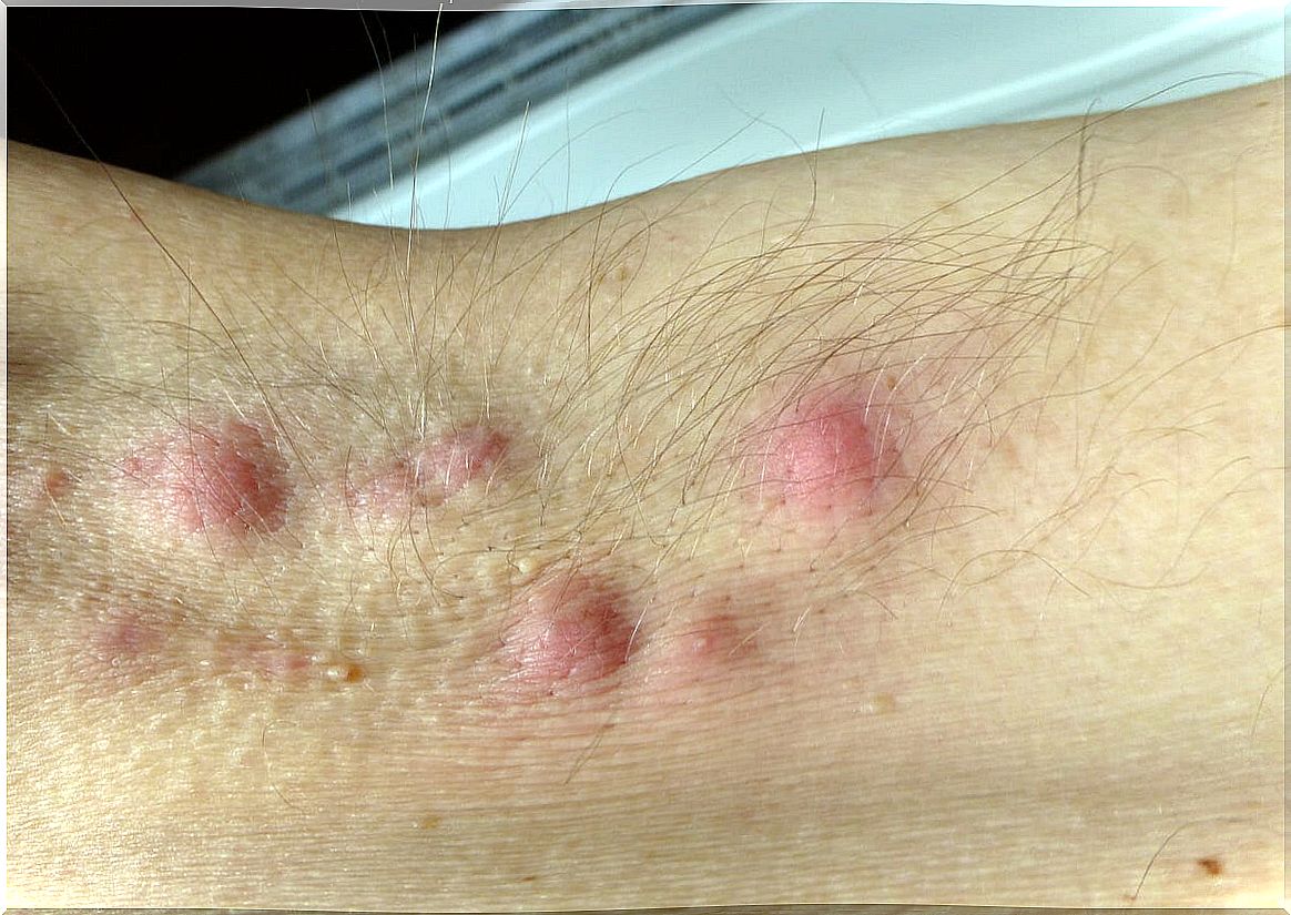 Nodules of hidradenitis suppurativa.