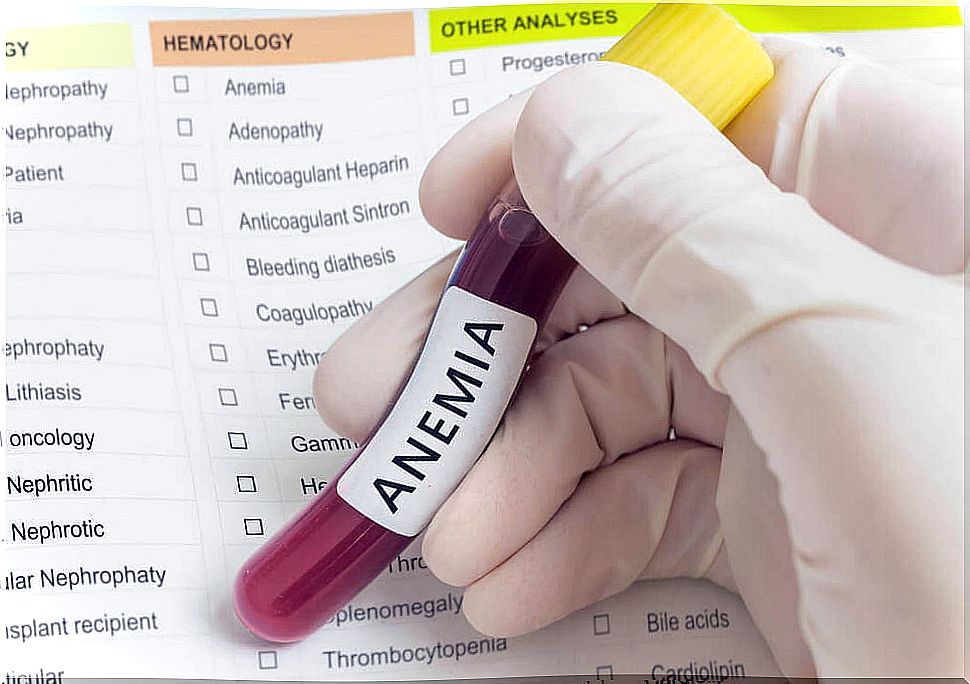 Iron deficiency anemia.