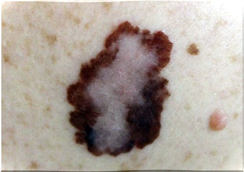 Risk-factors-and-types-of-malignant-melanoma