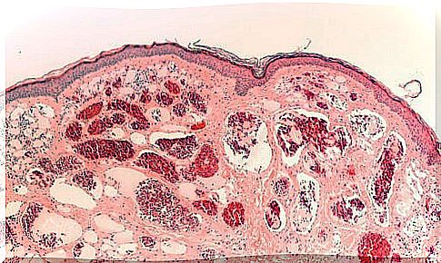 Types of neurofibromatosis v