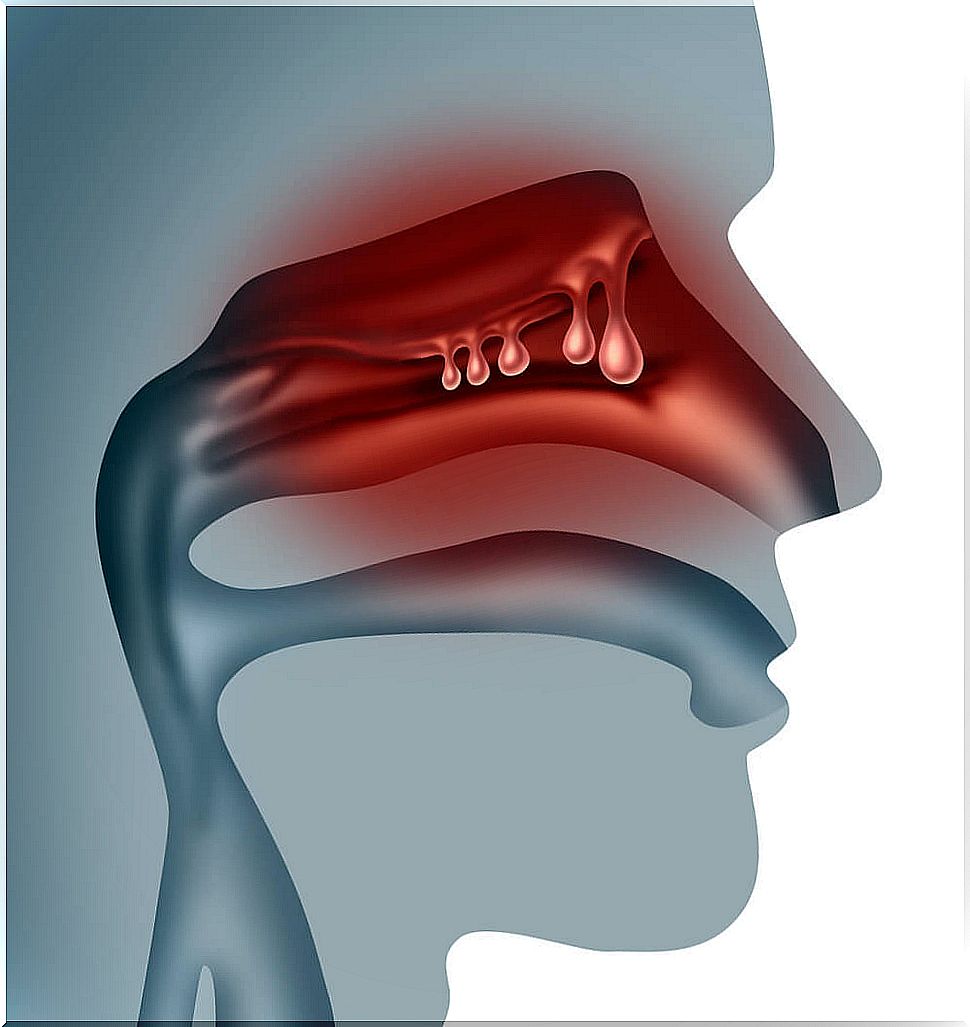 nasal polyps