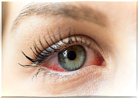 Red eyes, common causes and their treatment