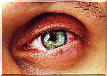 Eye with conjunctivitis 