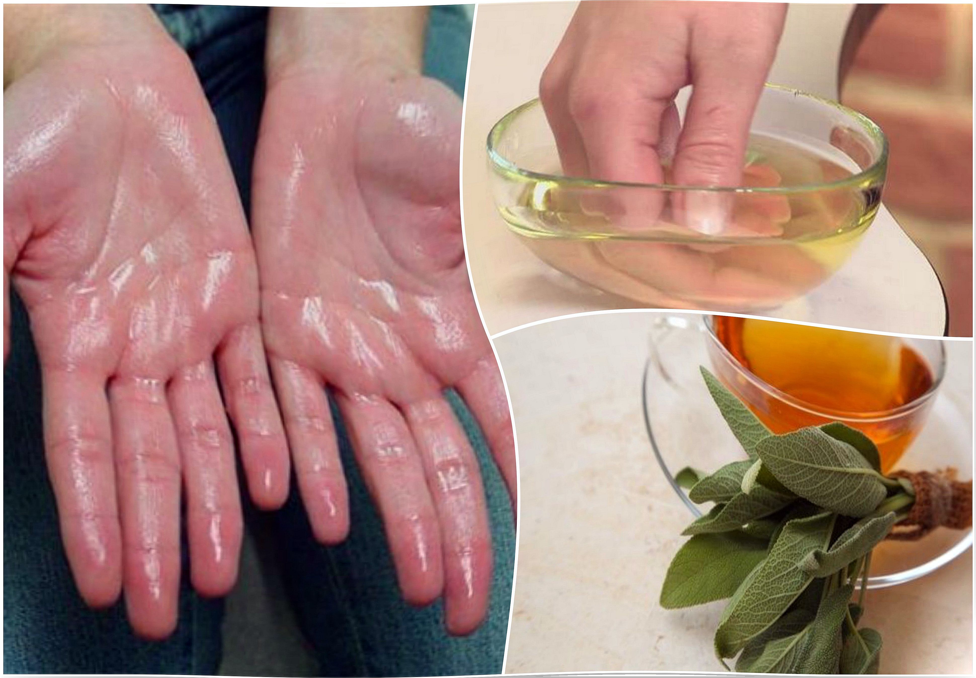 Relieve palmar hyperhidrosis with these 7 natural remedies